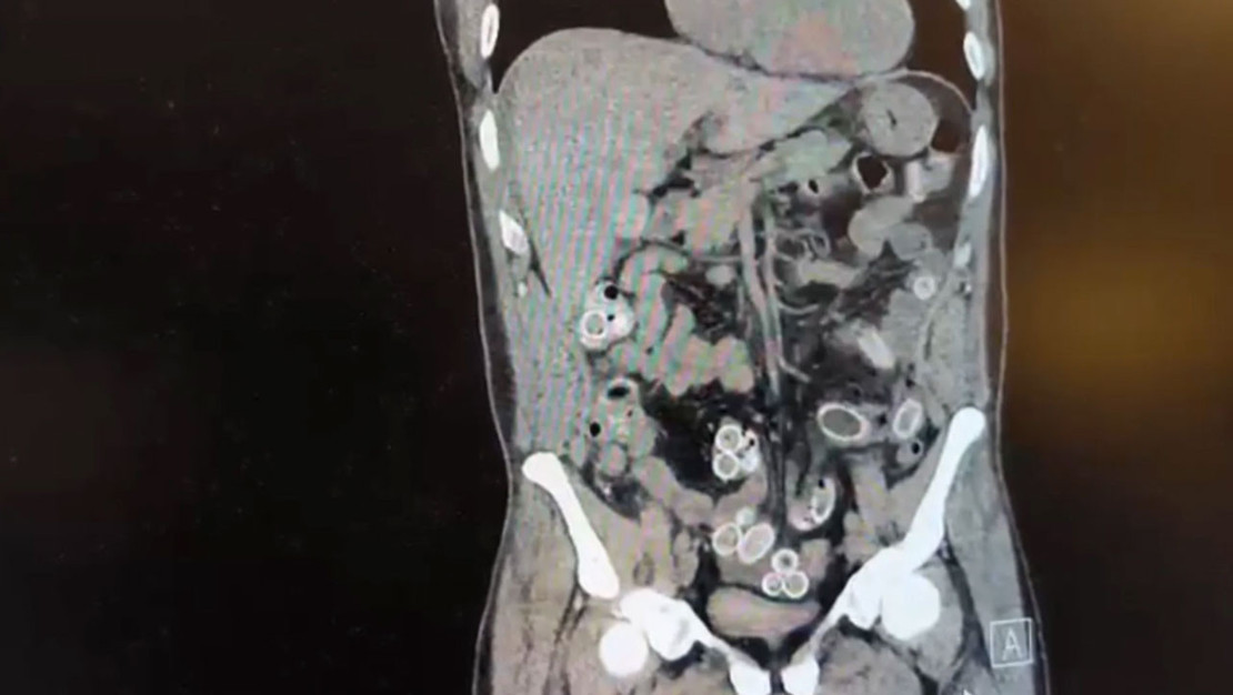 besiktas-ta-yabanci-maddelerle-dolu-mide-ameliyati