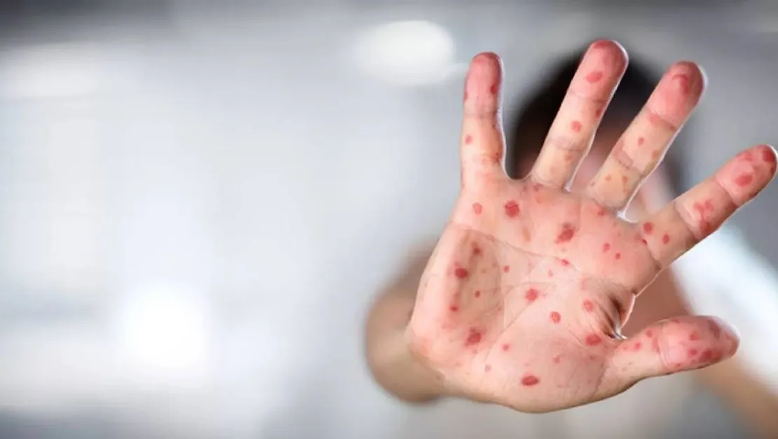 azerbaycan-da-ilk-mpox-vakasi-tespit-edildi