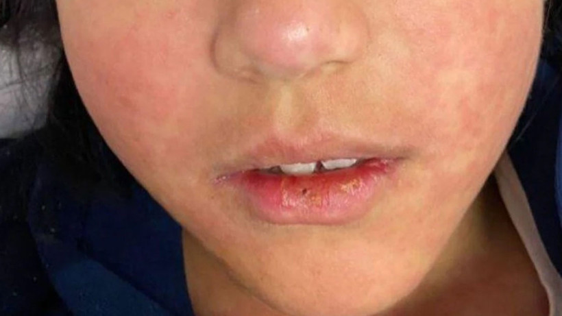 kizamik-salgini-6-haftada-227-cocuk-hayatini-kaybetti