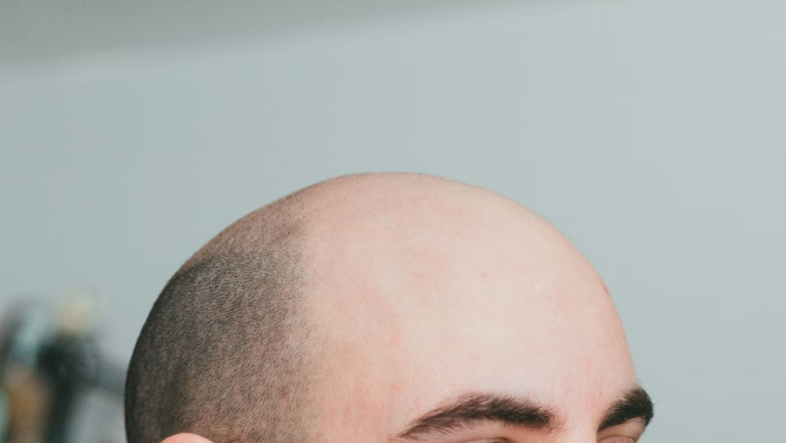 yeni-ilacla-erkek-tipi-sac-dokulmesinde-cigir-acildi