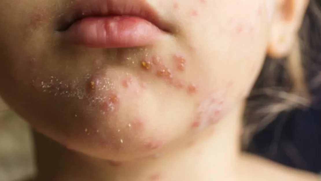 avrupa-da-27-yilin-en-yuksek-kizamik-vakalari