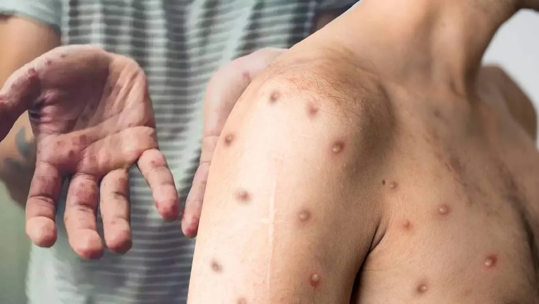 sierra-leone-de-mpox-vaka-sayisi-artiyor