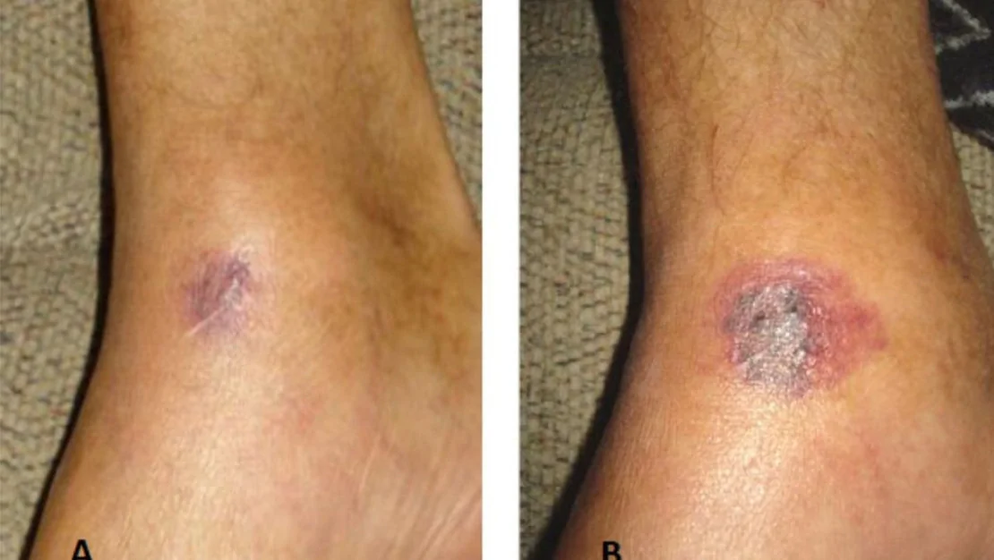 turkiye-de-et-yiyen-bakteri-vakasi-yok