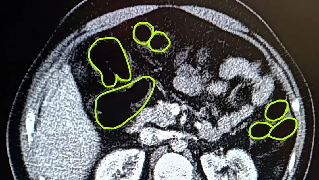 iranli-3-suphelinin-midesinde-uyusturucu-bulundu