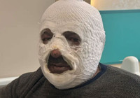 otlukbeli-maden-ocaginda-yanik-vakasi-yasandi