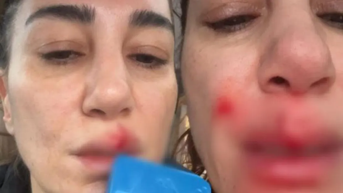 evde-talihsiz-kaza-gecirdi-dudagi-yaralandi